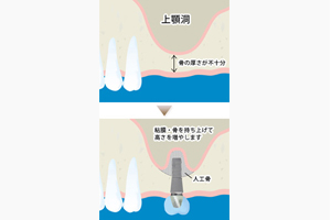 骨を増やす治療法1 サイナスリフト